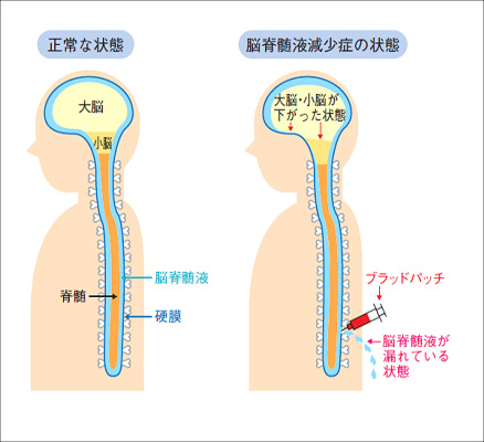 脳脊髄液減少症画像